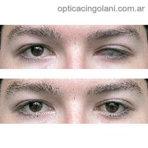 Lentes de contacto protésicas Iris Print